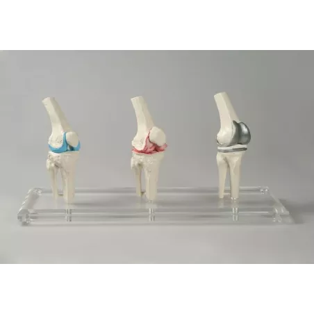 Modèle implant genou