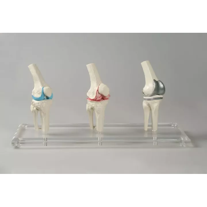 Modèle implant genou