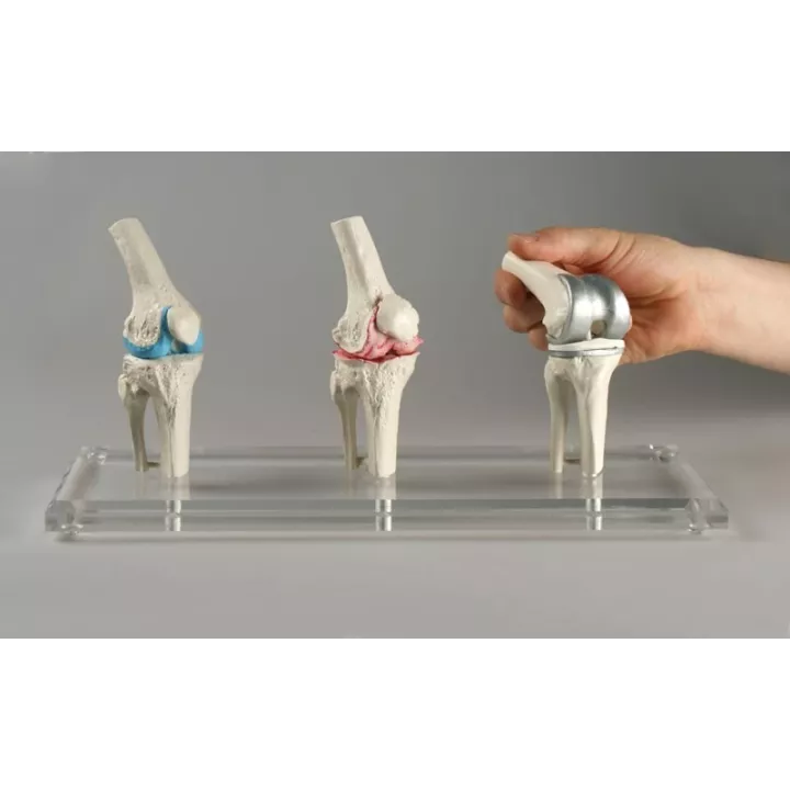 Modèle implant genou