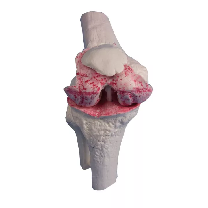 Modèle implant genou