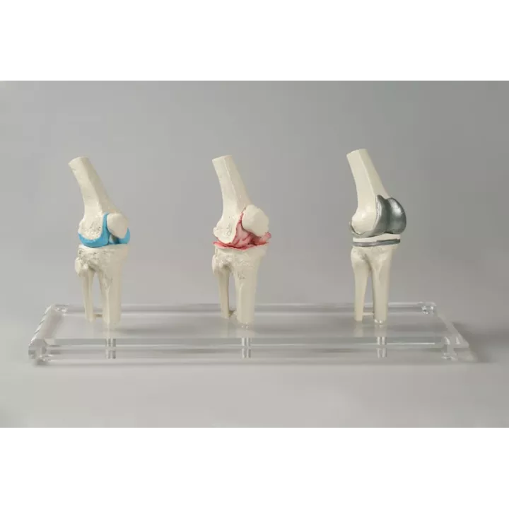 Modèle implant genou
