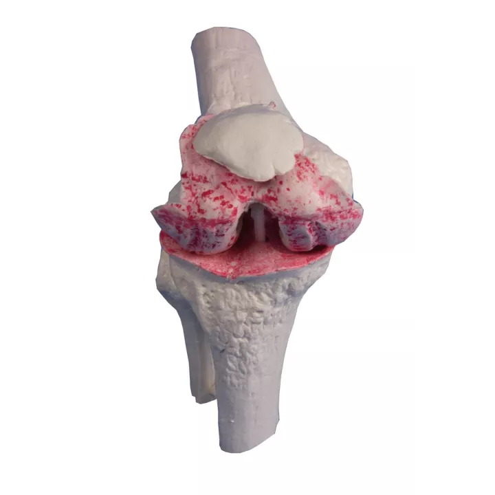 Modèle implant genou