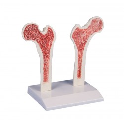 Modèle d'ostéoporose du fémur