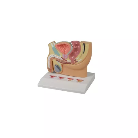 Modèle d'une section d'un pelvis Homme, avec maladie de la prostate