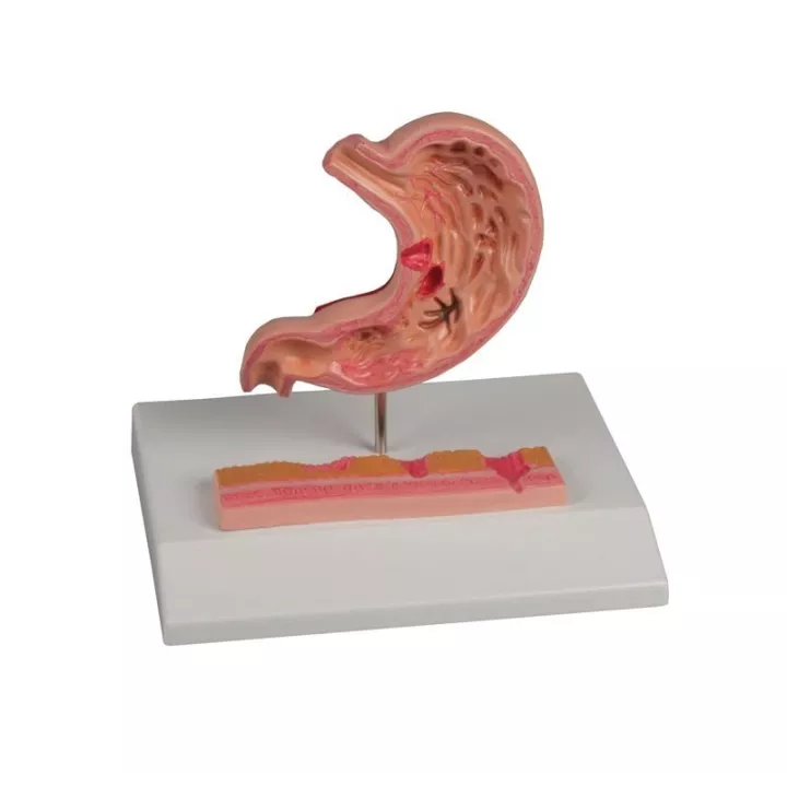 Modèle d'un estomac avec des ulcères