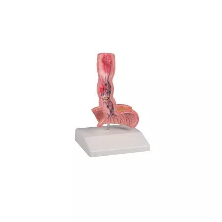 Maladies de l'oesophage