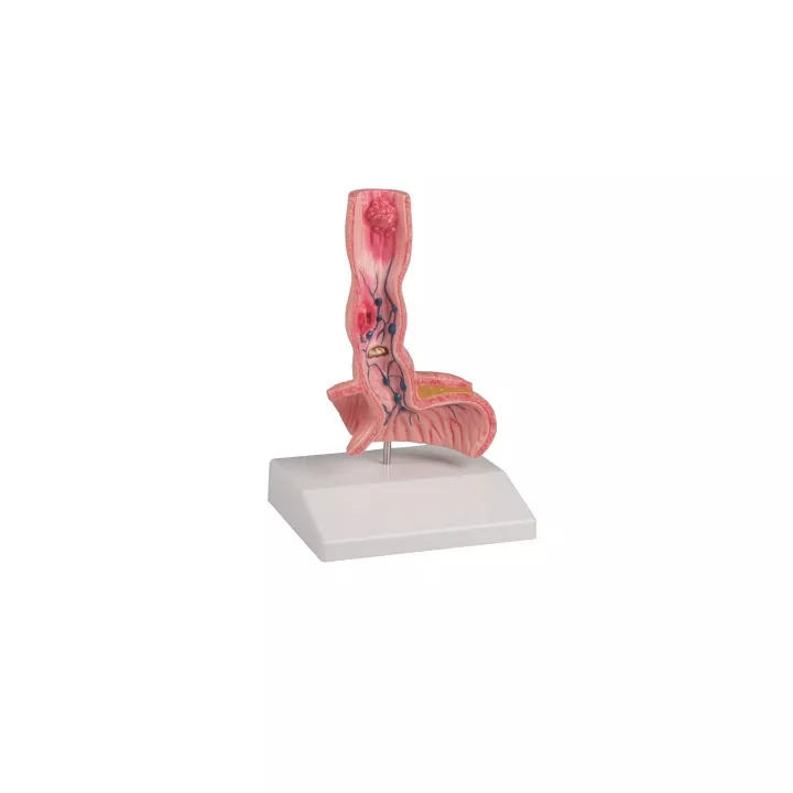 Maladies de l'oesophage