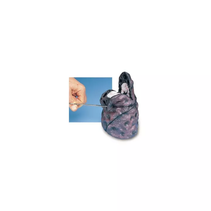 Modèle de Cancer du poumon