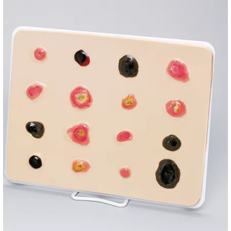 Modèle de cancer de la peau