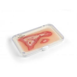 Modèle d'une blessure par ébouillantage