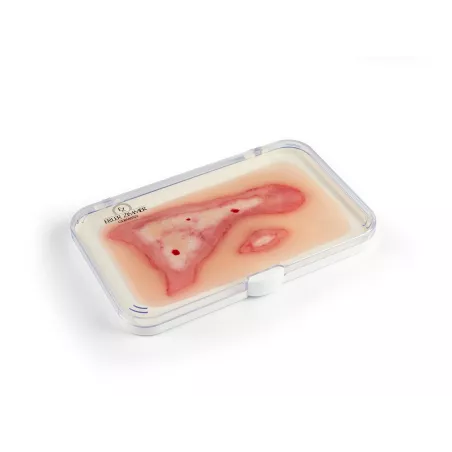 Modèle d'une blessure par ébouillantage