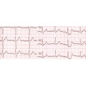 ECG et Dopplers