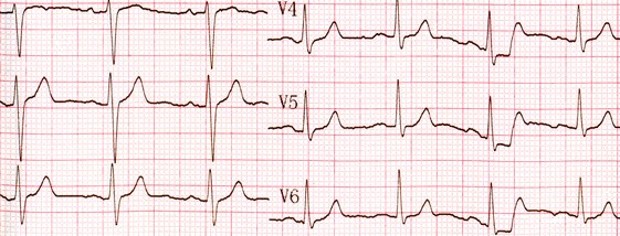 ECG et Dopplers